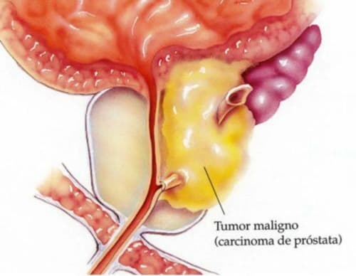 Urogen Forte donde lo venden